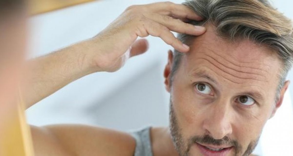 Saç ekimiyle ilgili doğru bilinen 6 yanlış #1